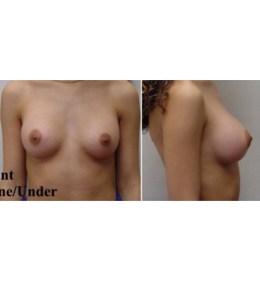 Transaxillary Breast Implants After